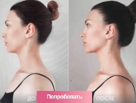 Подтяжка лица фото до и после женщины